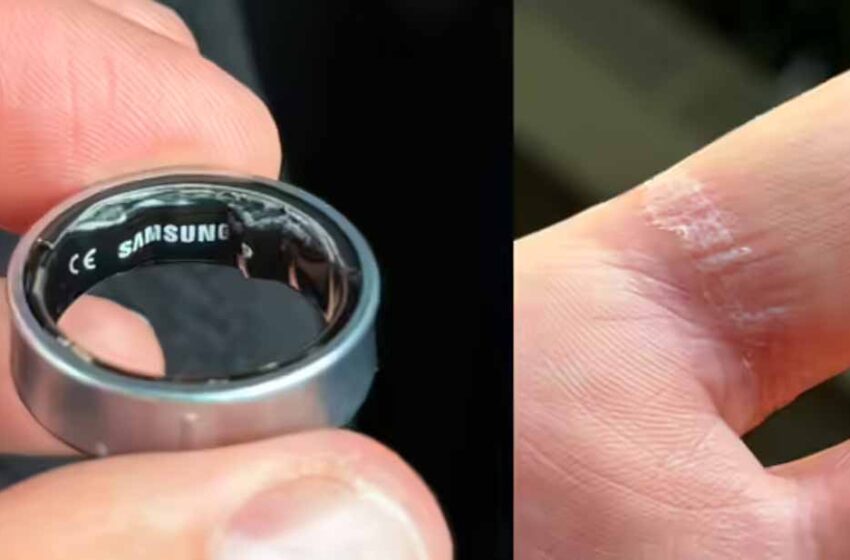  हवाई सफर में अड़चन: उंगली में फंसी स्‍मार्ट रिंग से बिगड़ी यात्री की हालत